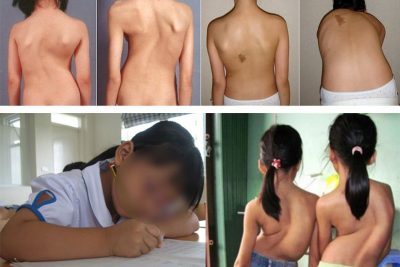 BÀI TUYÊN TRUYỀN PHÒNG CHỐNG BỆNH CONG VẸO CỘT SỐNG, BỆNH CẬN THỊ.